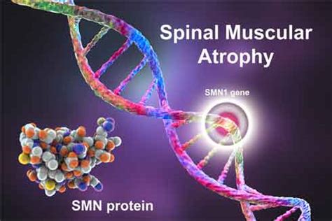 Spinal Muscle Atrophy: Is There a Cure?