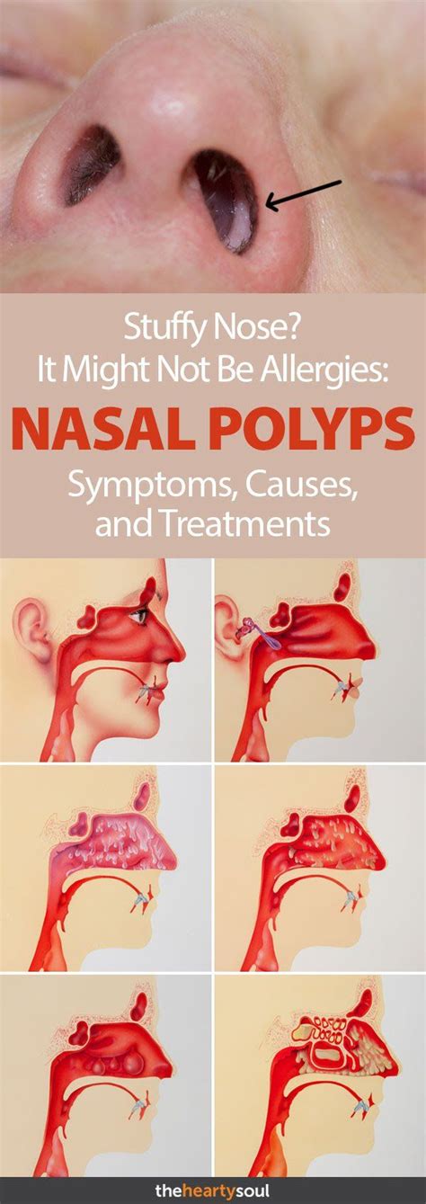 Nasal Polyps Causes