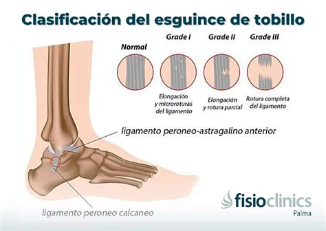 Diferencia Entre Esguince De Tobillo Y Fractura Con Tabla General | The Best Porn Website