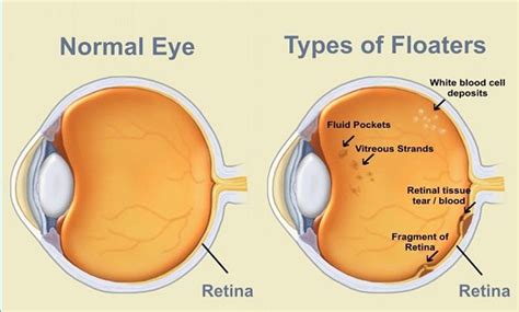 Eye Floaters | New Health Guide