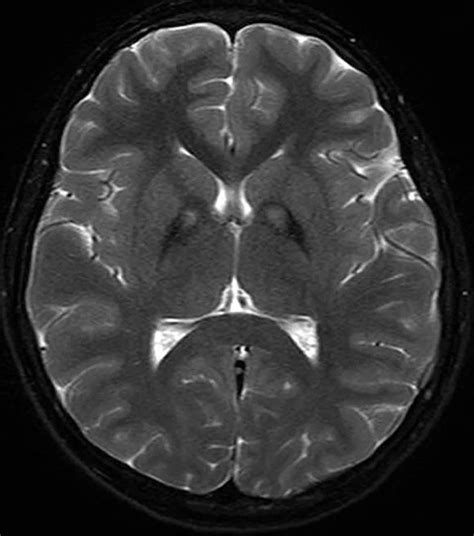 MRI Brain Scans Detect People with Early Parkinson's - Neuroscience News