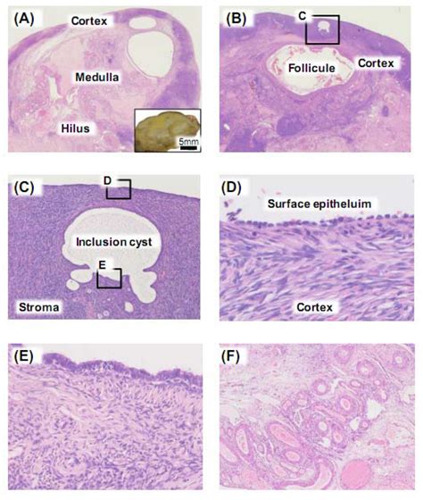 Cancers | Free Full-Text | Ovarian Cancer Stroma: Pathophysiology and the Roles in Cancer ...