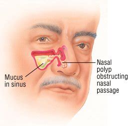 Acute Sinusitis Guide: Causes, Symptoms and Treatment Options