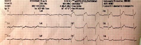 Wellens Syndrome • LITFL • ECG Library Eponym