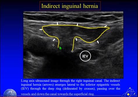 If we move a little bit medial to position 3, we are looking at the ...