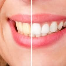 Cosmetic Dentistry Safe Effective Tooth Bleaching Olathe KS