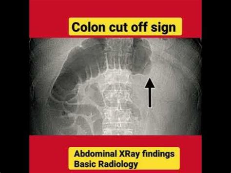 Colon cut off sign - Abdominal XRay findings - Basic Radiology - YouTube