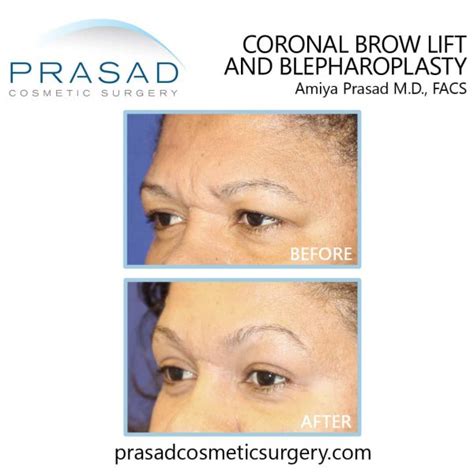 Brow Lift Before and After Photos | Manhattan and Long Island NY