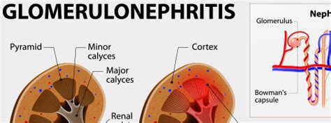 Glomerulonephritis: Causes, Symptoms and Treatment