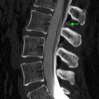 CT myelogram of the lumbar spine revealing extradural contrast... | Download Scientific Diagram