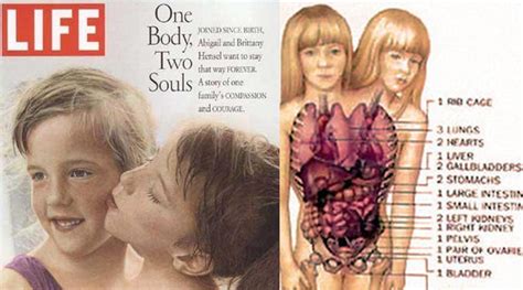 Brittany Famous Conjoined Twins, 12 Amazing facts about the world's most famous conjoined ...