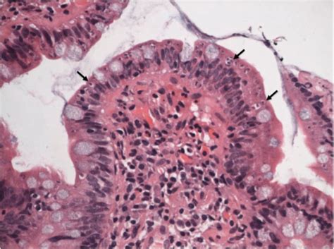 Histology of terminal ileum showing villus blunting and the presence of... | Download Scientific ...