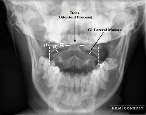 Chamberlain Line on Radiographic Image