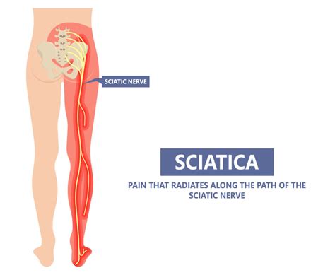 Best Sciatica Treatment in Cary, NC | Shiva Physical Therapy