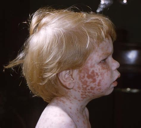 Rubella Symptoms Pictures – 25 Photos & Images / illnessee.com