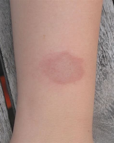 round rash on arm - pictures, photos