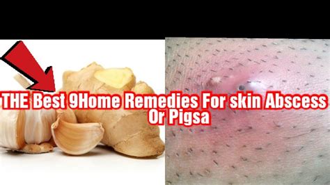 THE best 9Home Remedies For Skin Abscess Or Pigsa. - YouTube