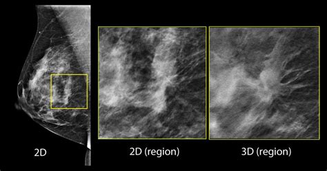 Breast Cancer Digital Mammogram