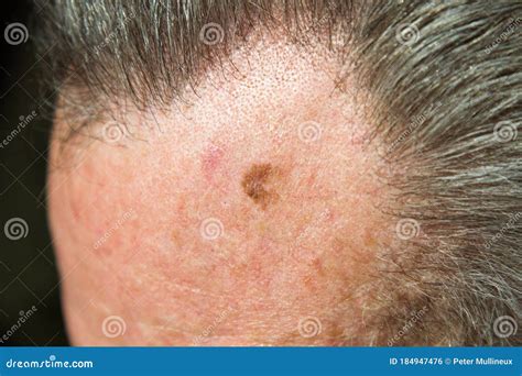 Lentigo Maligna, Melanoma in Situ Stock Photo - Image of prolonged, exposure: 184947476