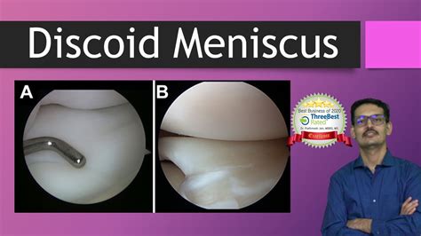 Discoid Meniscus : All You want to know (Discoid Lateral Meniscus ...