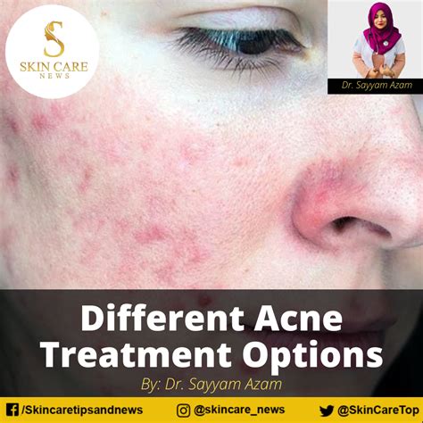 Different Acne Treatment Options