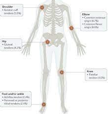 Physical Therapy for the Win in Managing Tendon Pain and Symptoms — Engage Physical Therapy