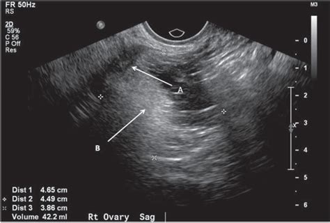 Ultrasound of ovarian dermoids – sonographic findings of a dermoid cyst in a 41‐year‐old woman ...