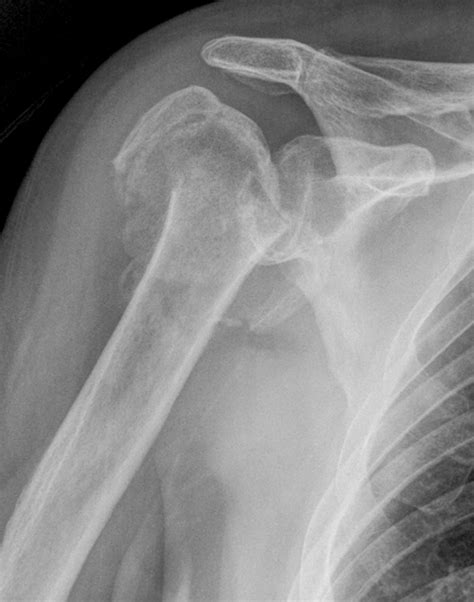 Fragility fractures around the shoulder - BallaratOSM | Ballarat Orthopaedics & Sports Medicine