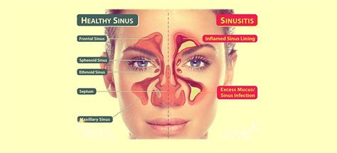 Recognizing Sinus Infection Symptoms and When to Seek Help