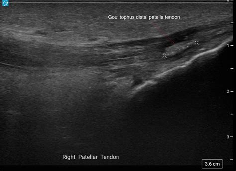 Acute Gout of the Knee - Ultrasound First