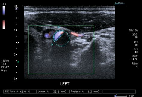 Quiz: Carotid artery ultrasound