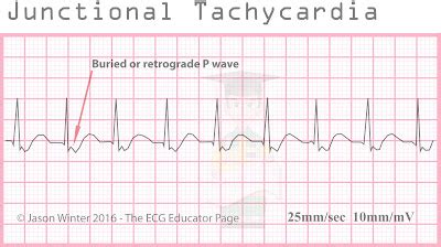 ECG Educator Blog : Junctional Rhythms