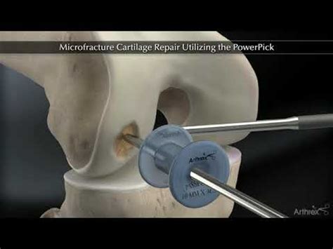 Micro Fracture Chondropick - YouTube