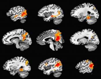 Posterior cingulate plays role in creating permanent memories | Neurons ...