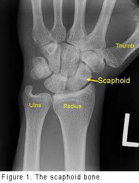 Scaphoid (Wrist Bone) Fracture - Orthopedic Specialists of Seattle