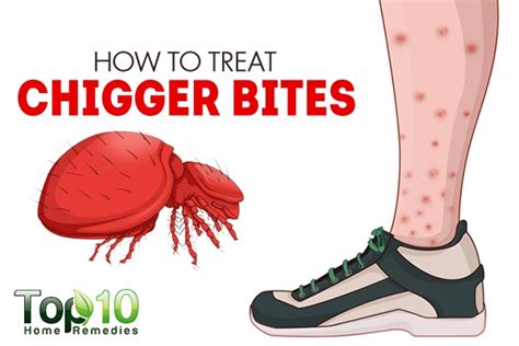 How to Treat Chigger Bites | Top 10 Home Remedies