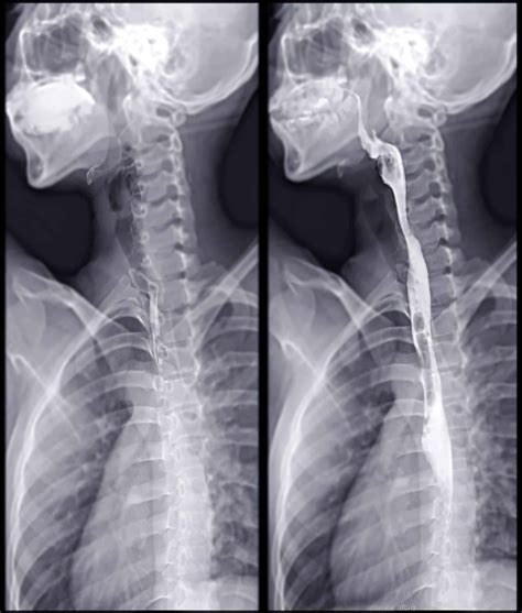 Barrett’s Oesophagus in Singapore - Alpha Digestive & Liver Centre