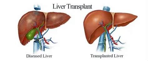 Liver Transplant Surgery in Gurgaon | ID: 20853438391