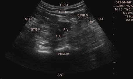 Popliteal Veins Ultrasound Anatomy