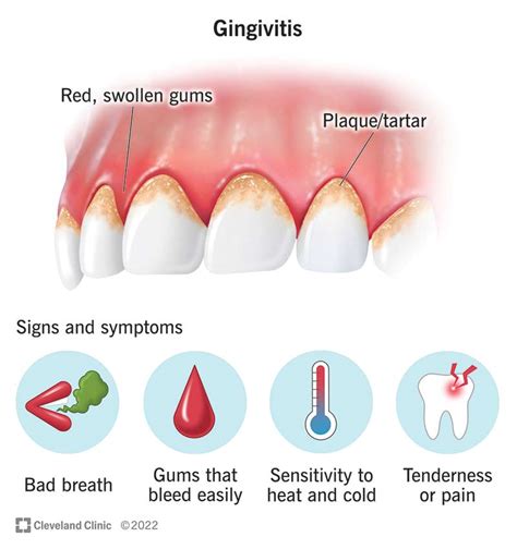 Gingivitis Causes Symptoms And Treatment Options | Hot Sex Picture