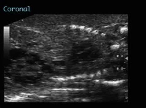 Multicystic kidney disease – ULTRASOUNDPAEDIA