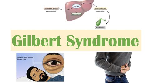 Gilbert Syndrome | Causes (Genetics), Pathogenesis, Signs & Symptoms ...