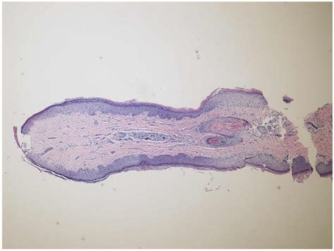 Acrochordon Histology