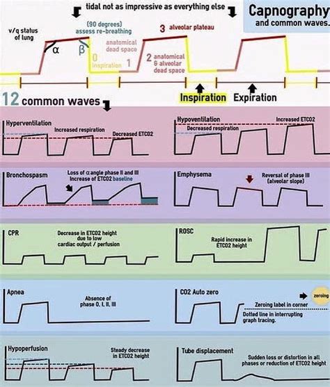 Normal End Tidal Co2 Waveform