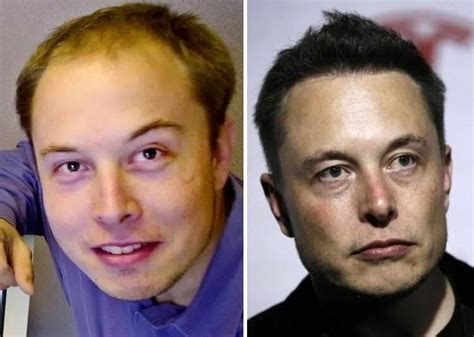 Elon Musk Before and After Plastic Surgery: Hair transplant