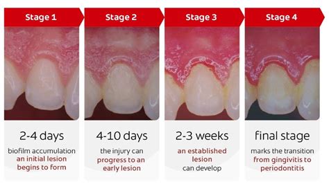 The importance of controlling bacterial biofilm re-growth in patients ...