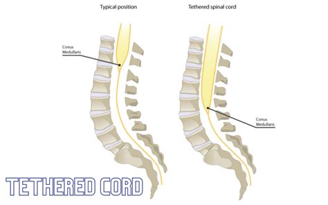 Tethered Cord – condition and symptoms - how to treat