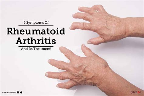 How to get rheumatoid arthritis