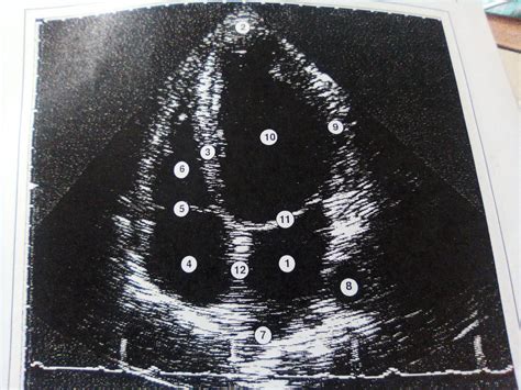 Apical 4 chamber view Diagram | Quizlet