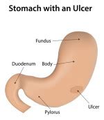 What's Behind Your Stomach Ulcer Symptoms? - University Health News